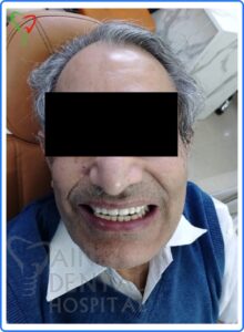 Full mouth rehabilitation by Dental Implant Full mouth rehabilitation through Dental implants at Jain Dental hospital Indirapuram, Ghaziabad & Noida, India
