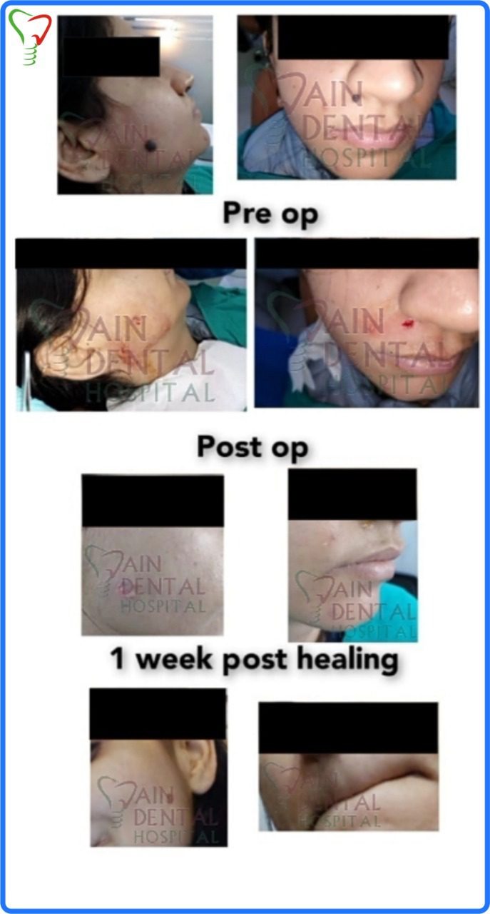 mole removal patient cosmetic aesthetic dentists mole removal patient cosmetic aesthetic dentists Jain Dental Hospital Indirapuram, Ghaziabad & Noida