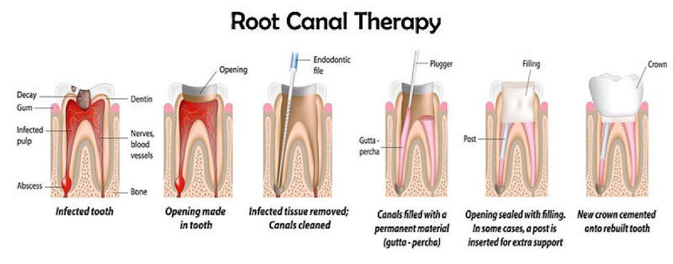 Different stages of Root Canal Treatment in order to get fully healed. Different stages of Root Canal Treatment at Jain Dental hospital