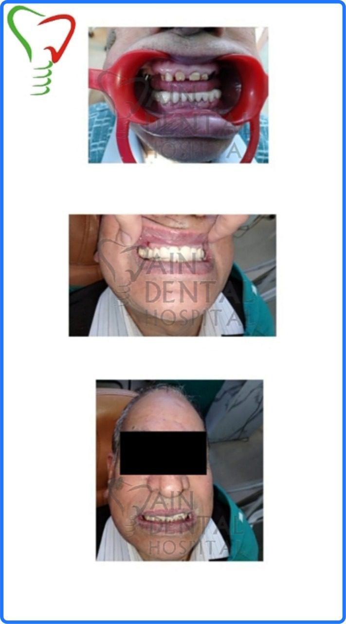 Full Mouth Rehabilitation by Dental Implants This picture shows the full mouth rehabilitation through dental implant at jain dental hospital at Indirapuram Ghaziabad & Noida, India
