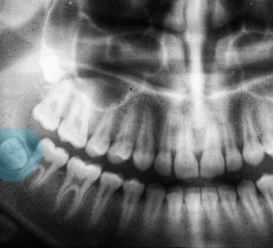 wisdom-teeth-removal