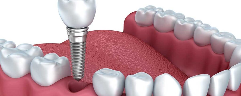 Feature image of Blog post Dental Implants: The Comprehensive Guide (2023)