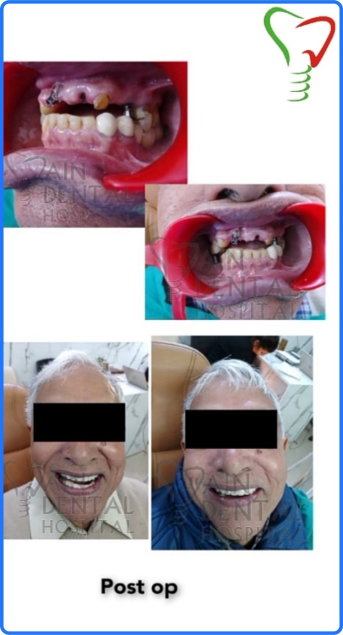 This image shows the condition of patient teeth before and after conducting All on 4 Dental implants full mouth rehabilitation. His surgery was conducted at Jain dental hospital Indirapuram, Ghaziabad & Noida, India