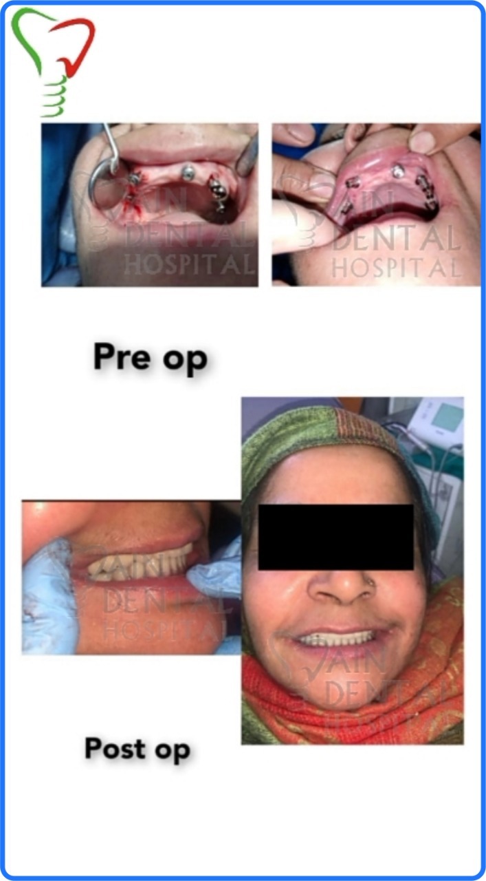This image shows the condition of patient teeth before and after all on 6 dental implants. Her surgery was conducted at Jain dental hospital at Indirapuram, Ghaziabad & Noida, India