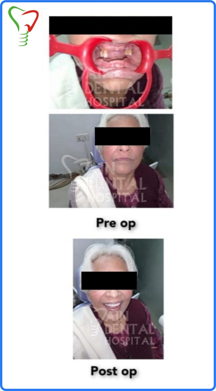 This image shows the condition of patient teeth before and after conducting dental implant surgery. Her surgery was conducted at Jain dental hospital, Indirapuram, Ghaziabad & Noida, India