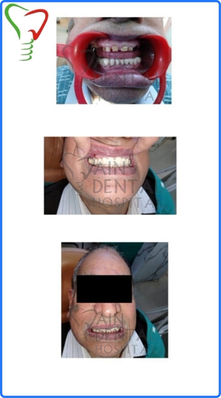 This picture shows the full mouth rehabilitation through dental implant at jain dental hospital at Indirapuram Ghaziabad & Noida, India