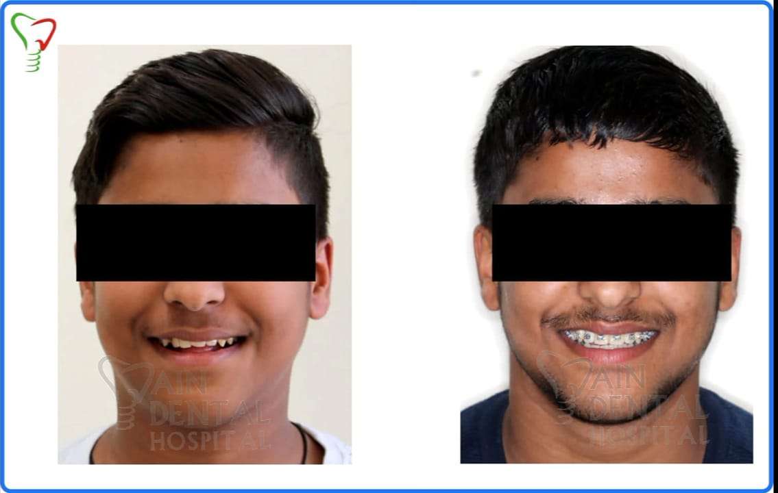 Patient Teeth condition before and after applying braces at jain Dental hospital, Indirapuram & Noida