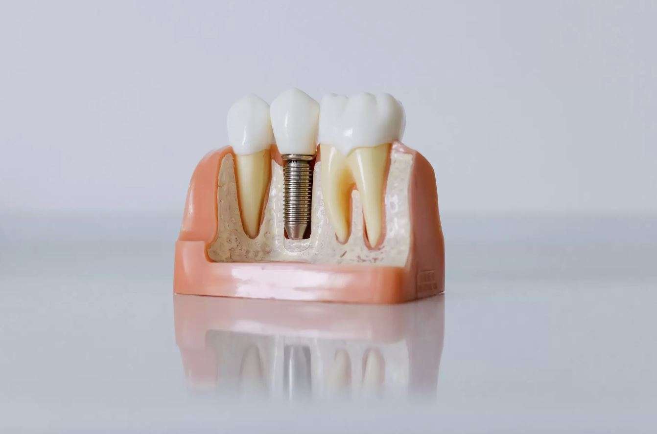 This image shows how dental implant looks like with the normal teeth.