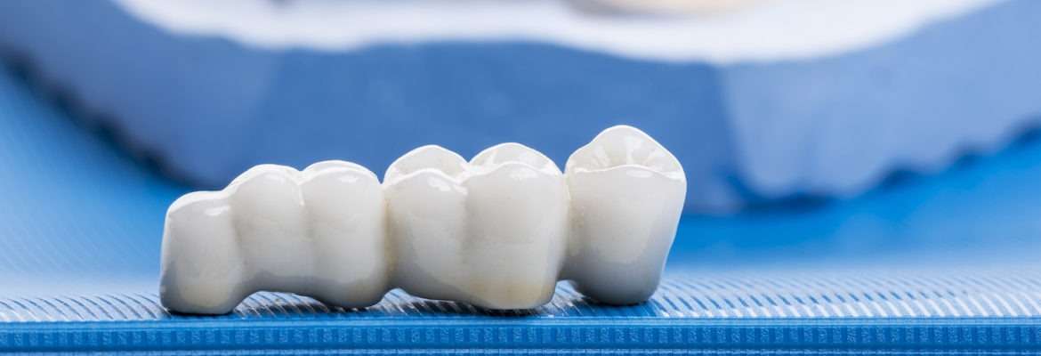 Feature Image of Dental Crowns and Bridges Jain Dental hospital