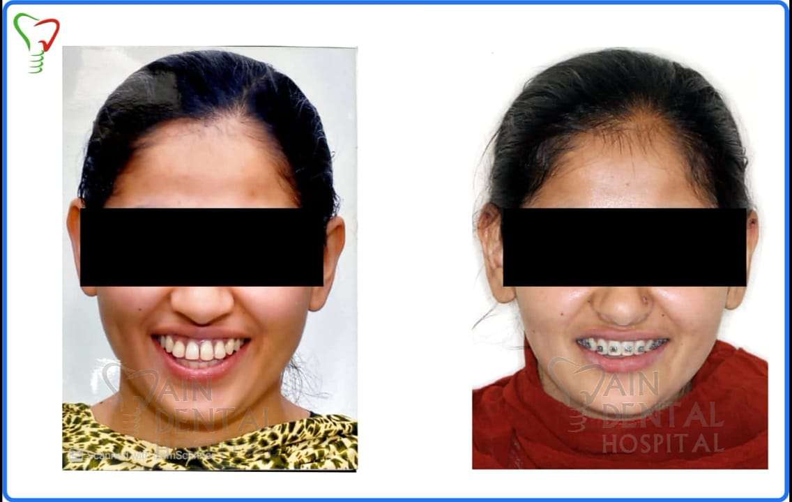 Patient Teeth condition before and after applying braces at Jain Dental hospital indirapuram