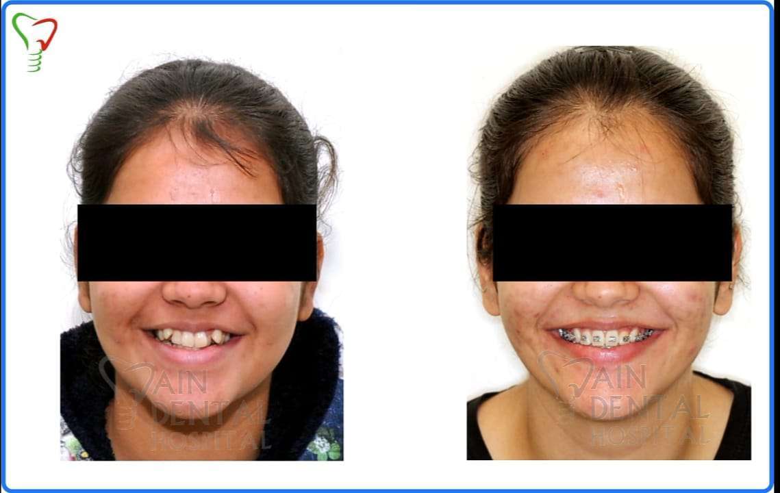 Girl patient Patient Teeth condition before and after applying Invisalign Aligners and braces