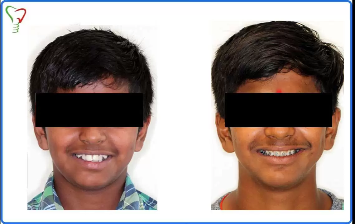 Patient's Teeth condition before and after applying Invisalign Clear Aligners and Braces. Jain Dental hospital Indirapuram, Ghaziabad & Noida