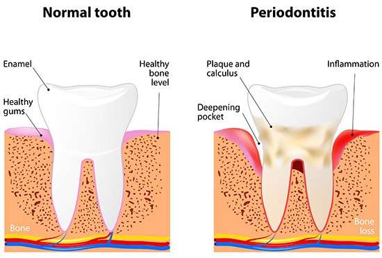 Stages of Gum Disease