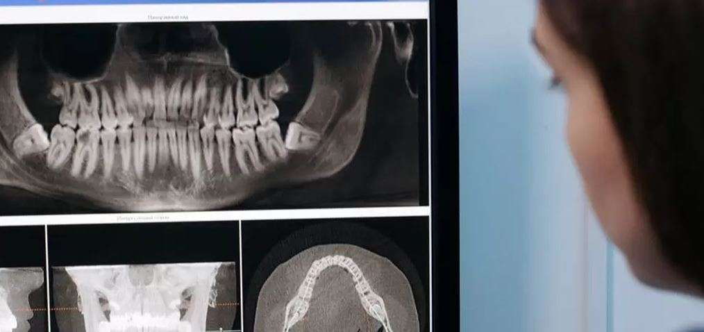 Wisdom Teeth Removal X ray at Jain Dental hospital