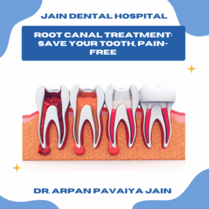 Illustration of root canal treatment showing tooth anatomy and dental procedure"