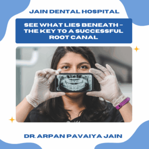 Dental X-ray illustrating the importance of X Ray in root canal treatment by revealing tooth roots, infection, and canal structure for precise diagnosis.