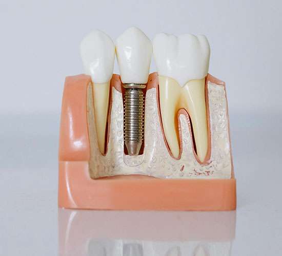 dental-implants
