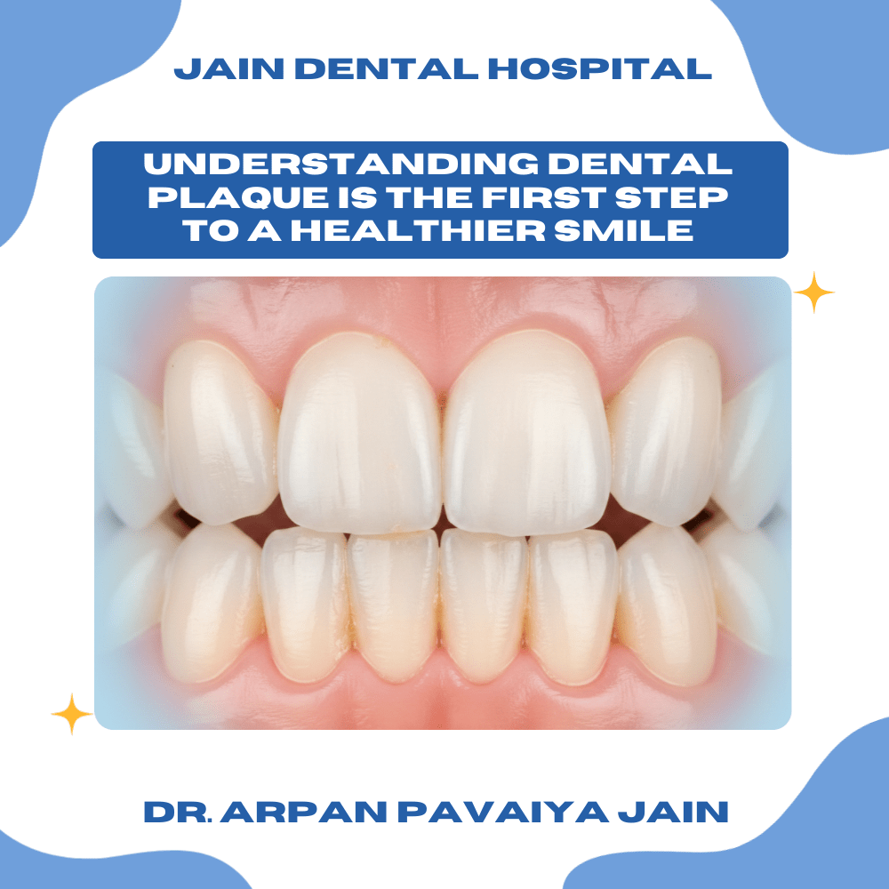 Illustration showing early dental plaque buildup on teeth near the gumline